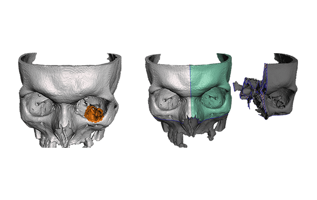 ZORTRAX 3D Printed Skull Facial Reconstruction Surgery